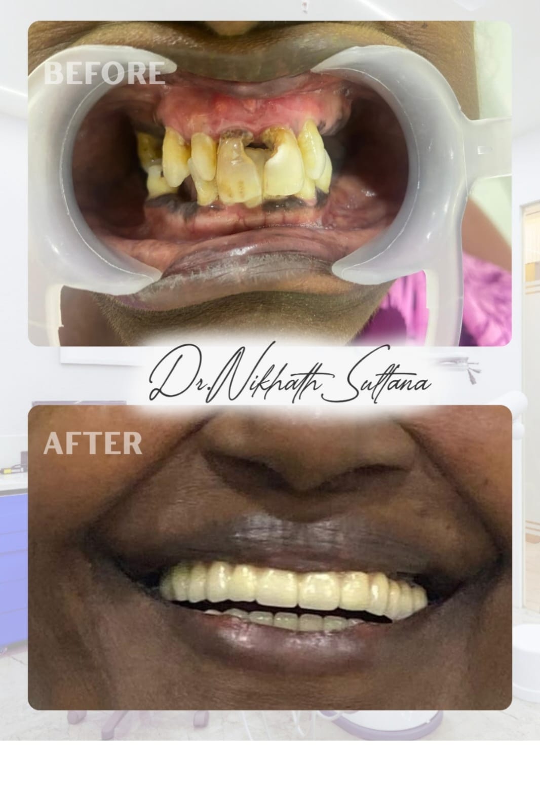 Full Mouth Implants