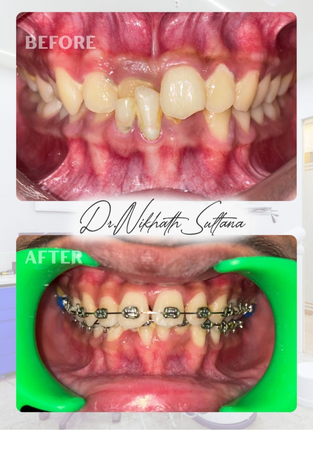 Teeth Alignment Results